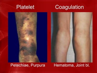 Platelet Coagulation
Petechiae, Purpura Hematoma, Joint bl.
 
