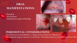 ORAL
MANIFESTATIONS:
• Petechiae
• Ecchymoses
• Spontaneous gingival bleeding
PERIODONTAL CONSIDERATIONS:
• In all but severe hemophiliacs, scaling can be carried out without LA.
• Periodontal surgery requires LA and factor VIII replacement to a level between 50 to 75%
 