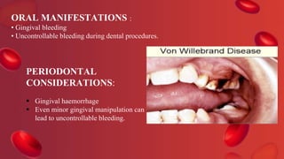 ORAL MANIFESTATIONS :
• Gingival bleeding
• Uncontrollable bleeding during dental procedures.
PERIODONTAL
CONSIDERATIONS:
 Gingival haemorrhage
 Even minor gingival manipulation can
lead to uncontrollable bleeding.
 