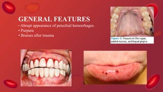 GENERAL FEATURES
• Abrupt appearance of petechial hemorrhages.
• Purpura
• Bruises after trauma
 