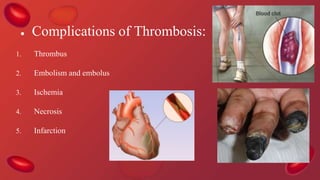 ● Complications of Thrombosis:
1. Thrombus
2. Embolism and embolus
3. Ischemia
4. Necrosis
5. Infarction
 