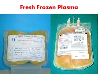 Fresh Frozen Plasma
 