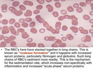 True Rouleaux Rbc Blood count | PPT