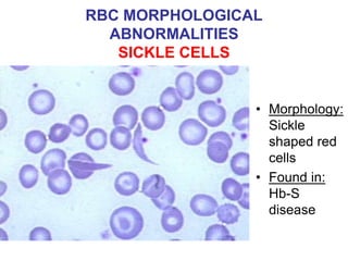 RBC MORPHOLOGICAL
ABNORMALITIES
SICKLE CELLS
• Morphology:
Sickle
shaped red
cells
• Found in:
Hb-S
disease
 