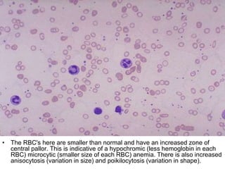 • The RBC's here are smaller than normal and have an increased zone of
central pallor. This is indicative of a hypochromic (less hemoglobin in each
RBC) microcytic (smaller size of each RBC) anemia. There is also increased
anisocytosis (variation in size) and poikilocytosis (variation in shape).
 