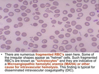 • There are numerous fragmented RBC's seen here. Some of
the irregular shapes appear as "helmet" cells. Such fragmented
RBC's are known as "schistocytes" and they are indicative of
a Microangiopathic hemolytic anemia (MAHA) or other
cause for intravascular hemolysis. This finding is typical for
disseminated intravascular coagulopathy (DIC).
 