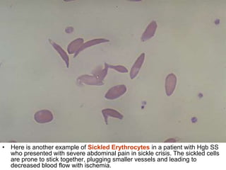 • Here is another example of Sickled Erythrocytes in a patient with Hgb SS
who presented with severe abdominal pain in sickle crisis. The sickled cells
are prone to stick together, plugging smaller vessels and leading to
decreased blood flow with ischemia.
 