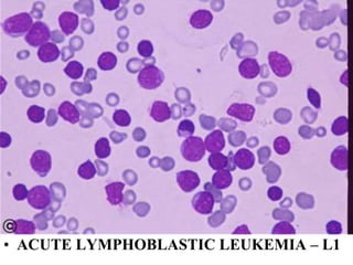 • ACUTE LYMPHOBLASTIC LEUKEMIA – L1
 