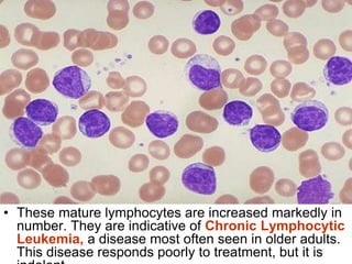 • These mature lymphocytes are increased markedly in
number. They are indicative of Chronic Lymphocytic
Leukemia, a disease most often seen in older adults.
This disease responds poorly to treatment, but it is
 