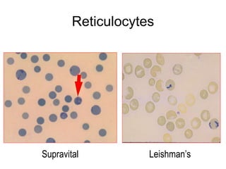 Reticulocytes
Leishman’sSupravital
 