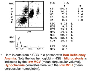 • Here is data from a CBC in a person with Iron Deficiency
Anemia. Note the low hemoglobin (HGB). Microcytosis is
indicated by the low MCV (mean corpuscular volume).
Hypochromia correlates here with the low MCH (mean
corpuscular hemoglobin).
 