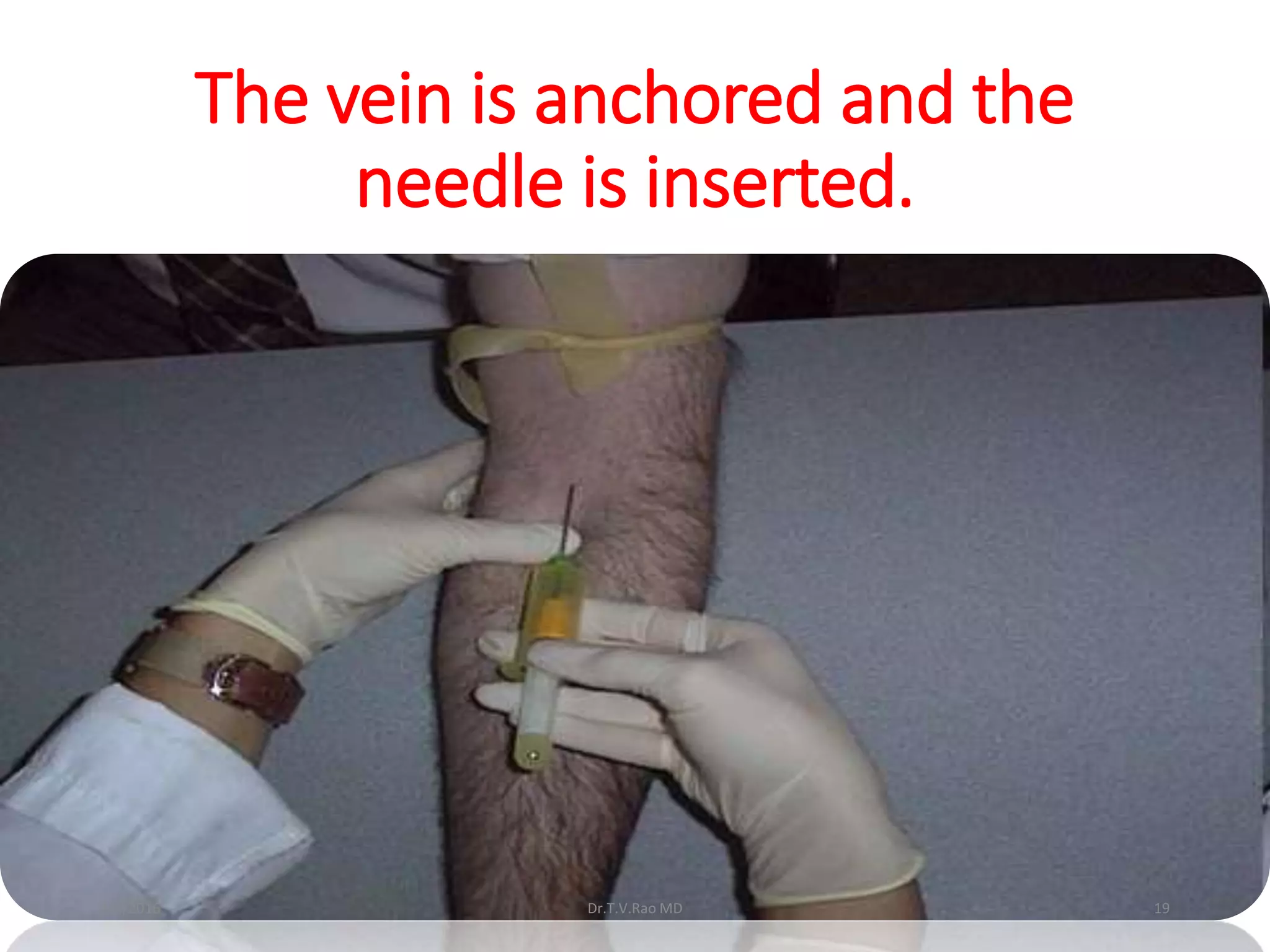 The vein is anchored and the
needle is inserted.
Dr.T.V.Rao MD 192/9/2016
 