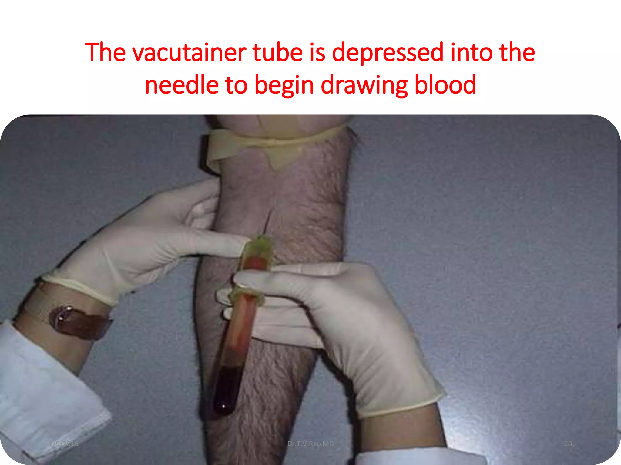 The vacutainer tube is depressed into the
needle to begin drawing blood
Dr.T.V.Rao MD 202/9/2016
 