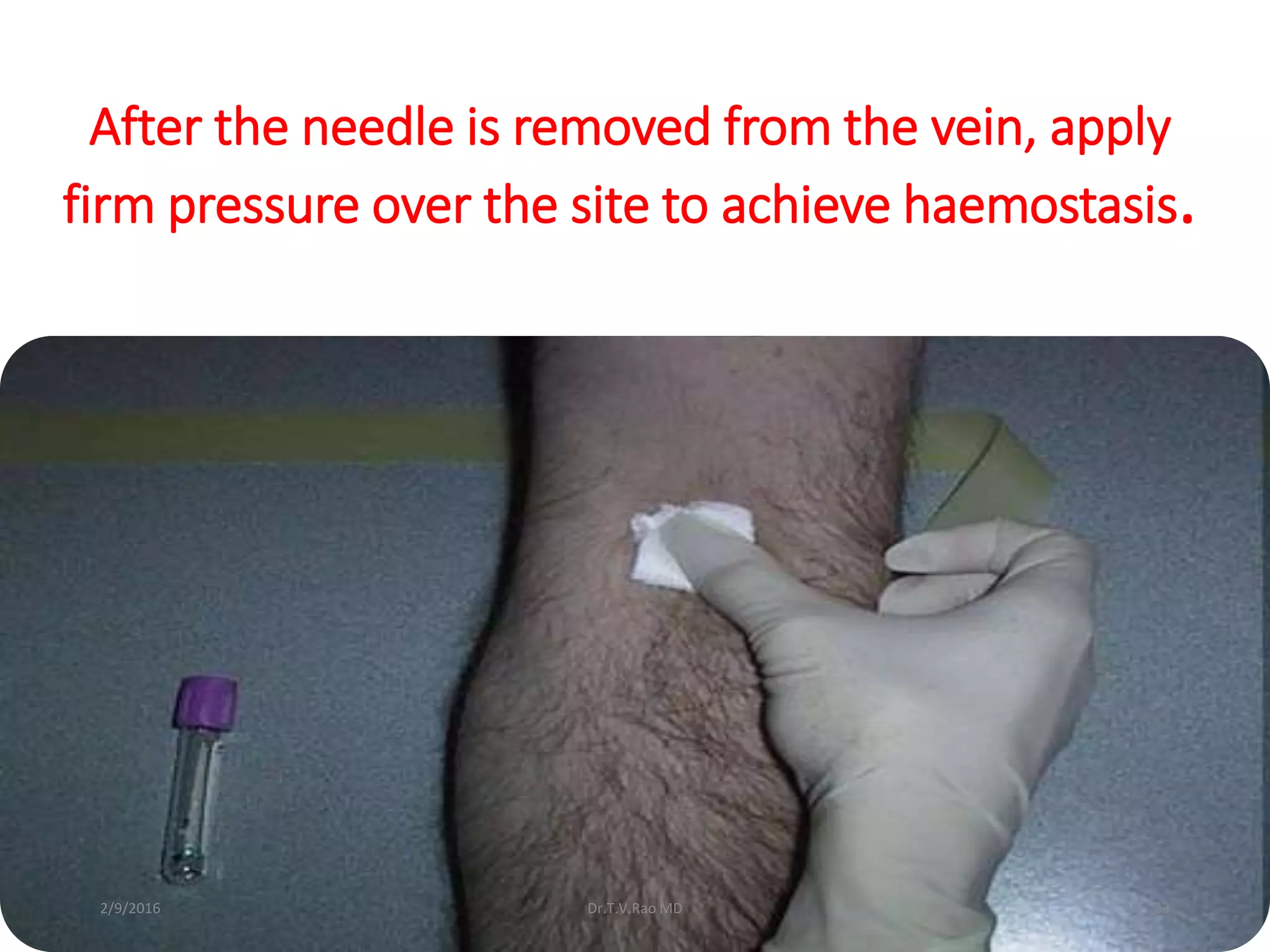 After the needle is removed from the vein, apply
firm pressure over the site to achieve haemostasis.
Dr.T.V.Rao MD 232/9/2016
 