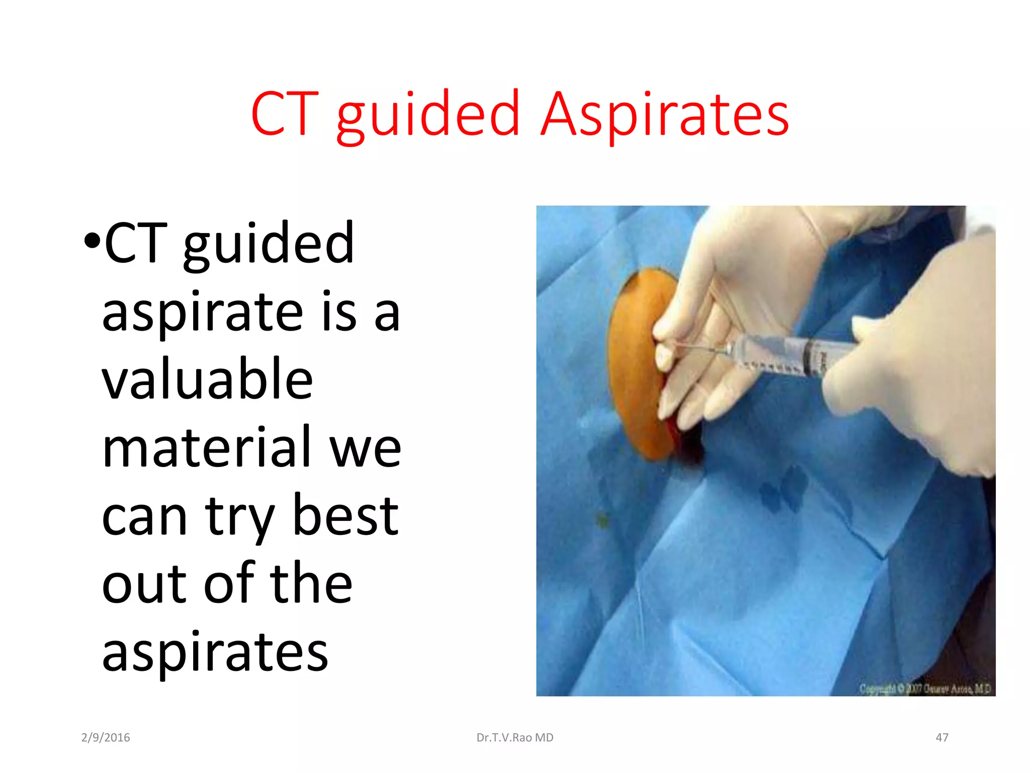 CT guided Aspirates
•CT guided
aspirate is a
valuable
material we
can try best
out of the
aspirates
Dr.T.V.Rao MD 472/9/2016
 