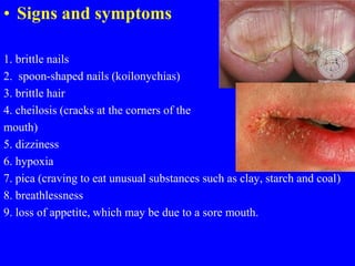 • Signs and symptoms
1. brittle nails
2. spoon-shaped nails (koilonychias)
3. brittle hair
4. cheilosis (cracks at the corners of the
mouth)
5. dizziness
6. hypoxia
7. pica (craving to eat unusual substances such as clay, starch and coal)
8. breathlessness
9. loss of appetite, which may be due to a sore mouth.
 