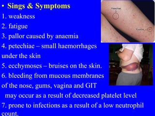 • Sings & Symptoms
1. weakness
2. fatigue
3. pallor caused by anaemia
4. petechiae – small haemorrhages
under the skin
5. ecchymoses – bruises on the skin.
6. bleeding from mucous membranes
of the nose, gums, vagina and GIT
may occur as a result of decreased platelet level
7. prone to infections as a result of a low neutrophil
count.
 