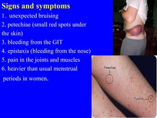 Signs and symptoms
1. unexpected bruising
2. petechiae (small red spots under
the skin)
3. bleeding from the GIT
4. epistaxis (bleeding from the nose)
5. pain in the joints and muscles
6. heavier than usual menstrual
periods in women.
 