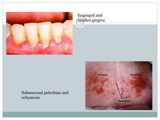 19
Engorged and
swollen gingiva
Submucosal petechiae and
echymosis
 