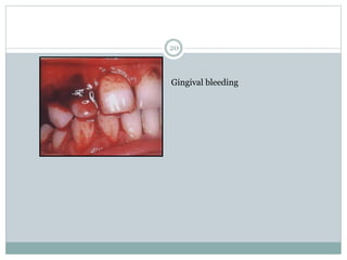 20
Gingival bleeding
 
