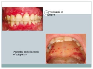 26Hyperaemia of
gingiva
Petechiae and echymosis
of soft palate
 