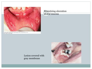 33
Necrotizing ulceration
of oral mucosa
Lesion covered with
gray membrane
 
