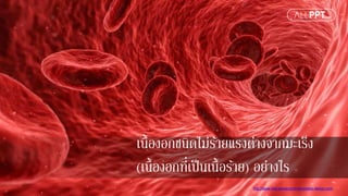 http://www.free-powerpoint-templates-design.com
เนื้องอกชนิดไม่ร้ายแรงต่างจากมะเร็ง
(เนื้องอกที่เป็นเนื้อร้าย) อย่างไร
 