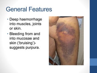 General Features
• Deep haemorrhage
into muscles, joints
or skin.
• Bleeding from and
into mucosae and
skin (‘bruising’)-
suggests purpura.
 