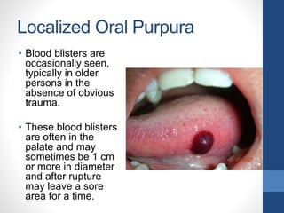 Localized Oral Purpura
• Blood blisters are
occasionally seen,
typically in older
persons in the
absence of obvious
trauma.
• These blood blisters
are often in the
palate and may
sometimes be 1 cm
or more in diameter
and after rupture
may leave a sore
area for a time.
 