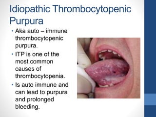 Idiopathic Thrombocytopenic
Purpura
• Aka auto – immune
thrombocytopenic
purpura.
• ITP is one of the
most common
causes of
thrombocytopenia.
• Is auto immune and
can lead to purpura
and prolonged
bleeding.
 