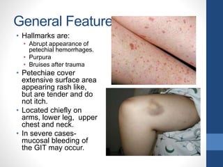 General Features
• Hallmarks are:
• Abrupt appearance of
petechial hemorrhages.
• Purpura
• Bruises after trauma
• Petechiae cover
extensive surface area
appearing rash like,
but are tender and do
not itch.
• Located chiefly on
arms, lower leg, upper
chest and neck.
• In severe cases-
mucosal bleeding of
the GIT may occur.
 