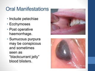 Oral Manifestations
• Include petechiae
• Ecchymoses
• Post operative
haemorrhage.
• Sumucous purpura
may be conspicous
and sometimes
seen as
“blackcurrant jelly”
blood blisters.
 