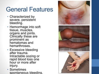 General Features
• Characterized by
severe, persistent
bleeding.
• Hemorrhage into soft
tissue, muscles,
organs and joints.
Clinically these are
prominent as
hematomas and
hemarthroses.
• Excessive bleeding
after trauma.
Intractable oozing or
rapid blood loss one
hour or more after
injury.
• Sometimes
spontaneous bleeding.
 