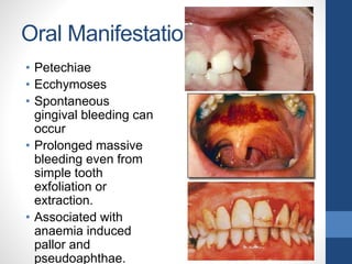 Oral Manifestations
• Petechiae
• Ecchymoses
• Spontaneous
gingival bleeding can
occur
• Prolonged massive
bleeding even from
simple tooth
exfoliation or
extraction.
• Associated with
anaemia induced
pallor and
pseudoaphthae.
 