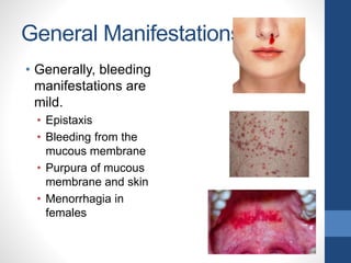 General Manifestations
• Generally, bleeding
manifestations are
mild.
• Epistaxis
• Bleeding from the
mucous membrane
• Purpura of mucous
membrane and skin
• Menorrhagia in
females
 