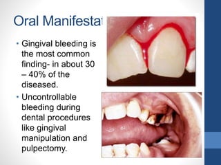 Oral Manifestations
• Gingival bleeding is
the most common
finding- in about 30
– 40% of the
diseased.
• Uncontrollable
bleeding during
dental procedures
like gingival
manipulation and
pulpectomy.
 