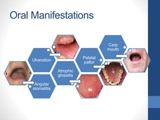 Oral Manifestations
Angular
stomatitis
Atrophic
glossitis
Ulceration
Palatal
pallor
Carp
mouth
 
