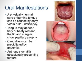 Oral Manifestations
• A physically normal,
sore or burning tongue
can be caused by early
Vitamin B12 deficiency.
• Tongue may appear
fiery or beefy red and
the tip and margins
show papillary atrophy.
• Candidiasis can be
precipitated by
anaemia.
• Apthous stomatitis
occasionally presenting
feature.
 