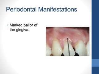 Periodontal Manifestations
• Marked pallor of
the gingiva.
 
