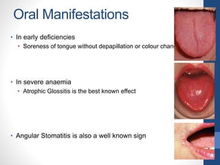 Oral Manifestations
• In early deficiencies
• Soreness of tongue without depapillation or colour change
• In severe anaemia
• Atrophic Glossitis is the best known effect
• Angular Stomatitis is also a well known sign
 