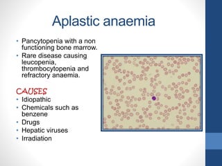 Aplastic anaemia
• Pancytopenia with a non
functioning bone marrow.
• Rare disease causing
leucopenia,
thrombocytopenia and
refractory anaemia.
CAUSES
• Idiopathic
• Chemicals such as
benzene
• Drugs
• Hepatic viruses
• Irradiation
 