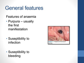 General features
Features of anaemia
• Purpura – usually
the first
manifestation
• Suseptibility to
infection
• Suseptibility to
bleeding
 