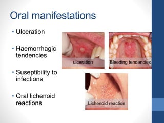 Oral manifestations
• Ulceration
• Haemorrhagic
tendencies
• Suseptibility to
infections
• Oral lichenoid
reactions
ulceration Bleeding tendencies
Lichenoid reaction
 