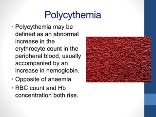 Polycythemia
• Polycythemia may be
defined as an abnormal
increase in the
erythrocyte count in the
peripheral blood, usually
accompanied by an
increase in hemoglobin.
• Opposite of anaemia
• RBC count and Hb
concentration both rise.
 