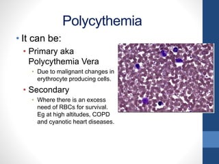 Polycythemia
• It can be:
• Primary aka
Polycythemia Vera
• Due to malignant changes in
erythrocyte producing cells.
• Secondary
• Where there is an excess
need of RBCs for survival.
Eg at high altitudes, COPD
and cyanotic heart diseases.
 