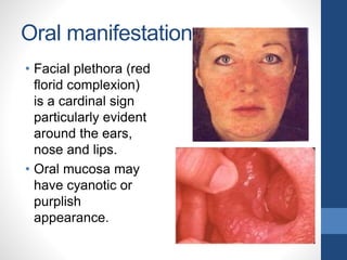 Oral manifestations
• Facial plethora (red
florid complexion)
is a cardinal sign
particularly evident
around the ears,
nose and lips.
• Oral mucosa may
have cyanotic or
purplish
appearance.
 