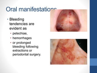 Oral manifestations
• Bleeding
tendencies are
evident as
• petechiae,
• hemorrhages
• or prolonged
bleeding following
extractions or
periodontal surgery.
 