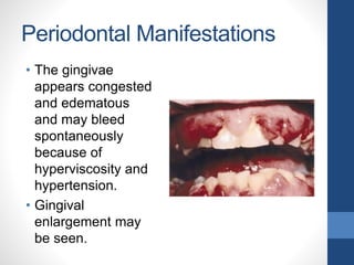 Periodontal Manifestations
• The gingivae
appears congested
and edematous
and may bleed
spontaneously
because of
hyperviscosity and
hypertension.
• Gingival
enlargement may
be seen.
 
