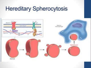 Hereditary Spherocytosis
 
