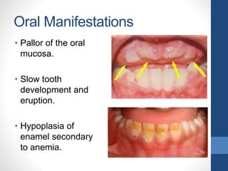 Oral Manifestations
• Pallor of the oral
mucosa.
• Slow tooth
development and
eruption.
• Hypoplasia of
enamel secondary
to anemia.
 